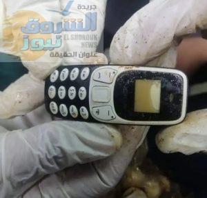استخراج هاتف محمول من معدة مريض