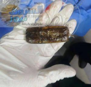 استخراج هاتف محمول من معدة مريض